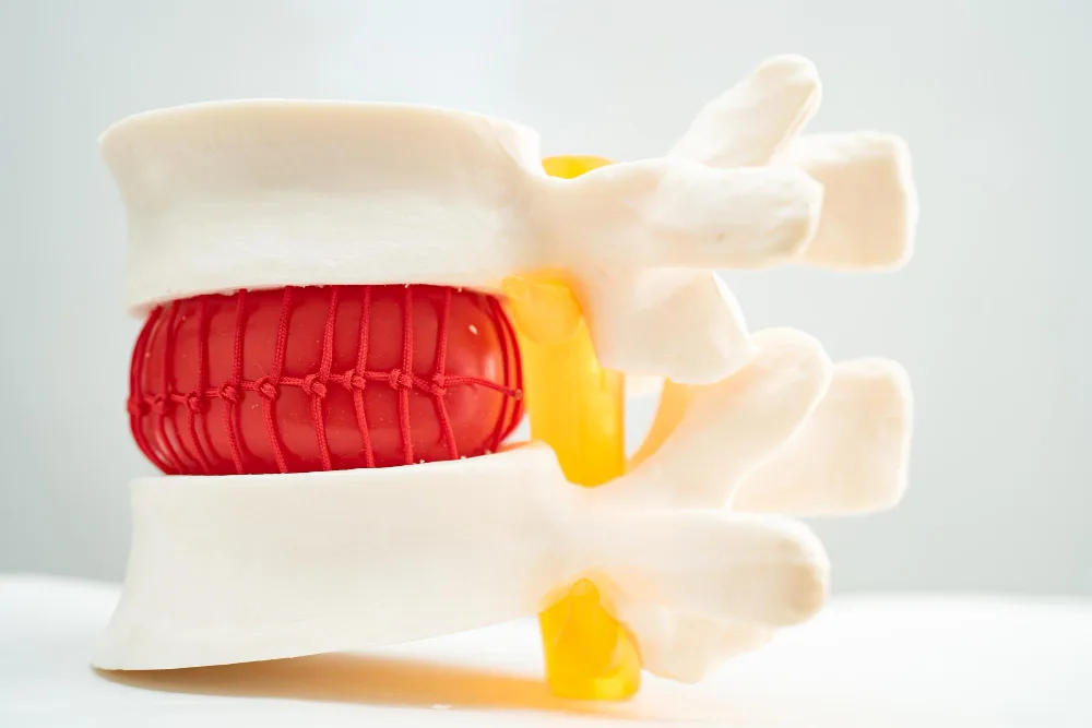 Hernia de disco cervical y canal cervical estrecho en Querétaro y Guanajuato: tratamiento neuroquirúrgico