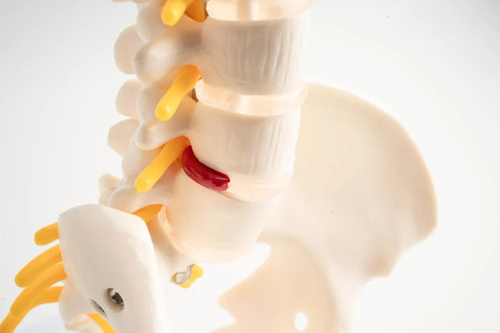 Hernia de disco lumbar en Querétaro y Guanajuato: diagnóstico y tratamiento neuroquirúrgico